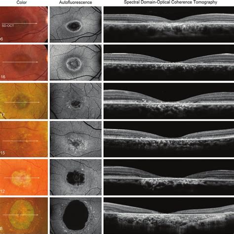 Retinal Phenotype On Color Photographs Autofluorescence Imaging And