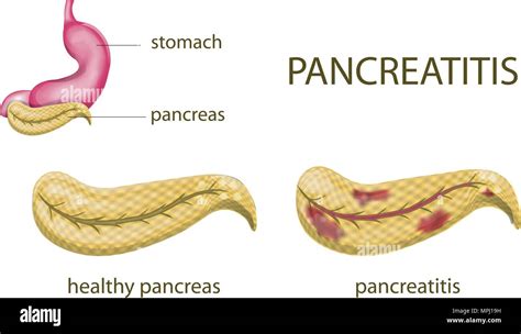 Illustration Of The Gaster Pancreas And Pancreatitis Stock Vector