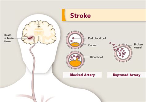 May Is National Stroke Prevention Month Ortonville Area Health Services