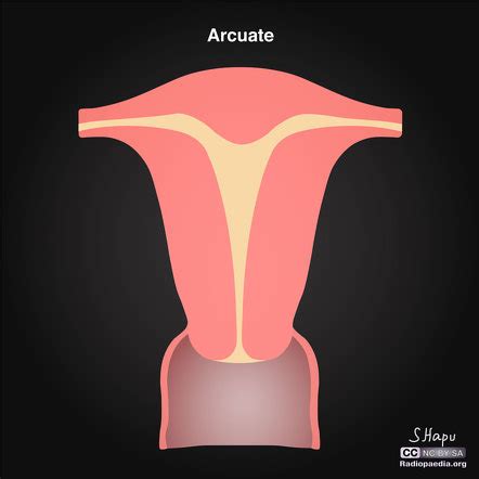Arcuate Uterus Radiology Reference Article Radiopaedia Org