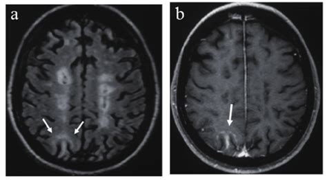 Mri On Initial Relapse Reveals A New Lesion In The Subcortical White