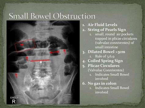 Small Bowel Obstruction 1