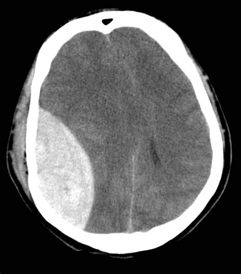 The features of a subdural vs an epidural hematoma differ based on ct findings, symptoms, location within the meninges, and pathophysiology. SUBDURAL VS EPIDURAL HEMATOMA RADIOLOGY - Wroc?awski ...