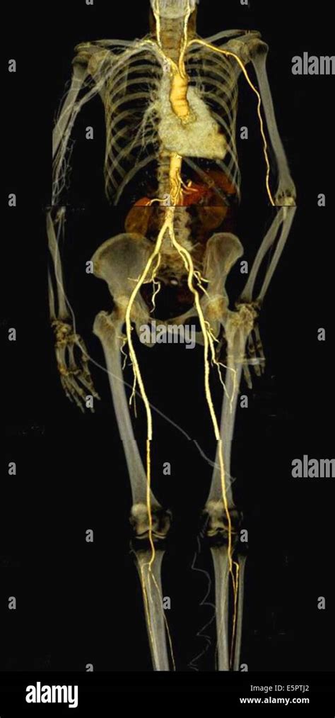 Ct Scan With 3d Reconstruction