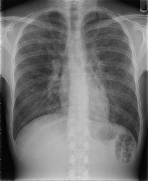 Pneumonia — Classification Diagnosis And Treatment Medical Library