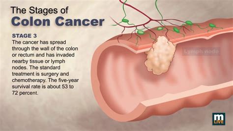 What Is Colon Cancer Cause Symptoms Stage And Treatment