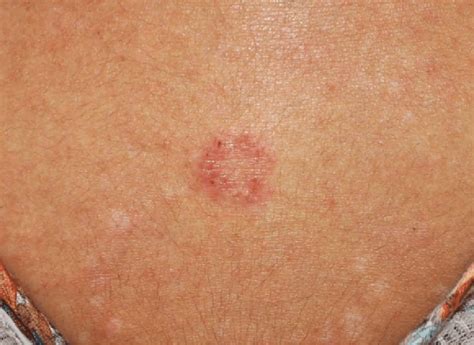 Ring Like Erythema On The Back Of A Patient With Ad Download