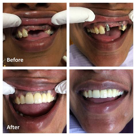 Tooth Implant Before After