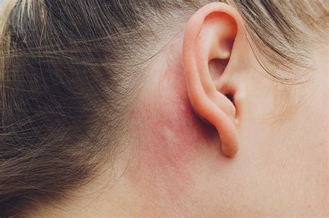 Ear Eczema Symptoms Causes Diagnosis K Health