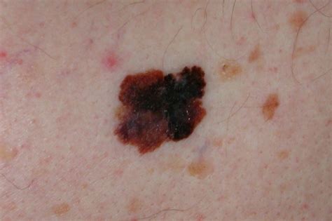 Malignant Melanoma Laser And Skin
