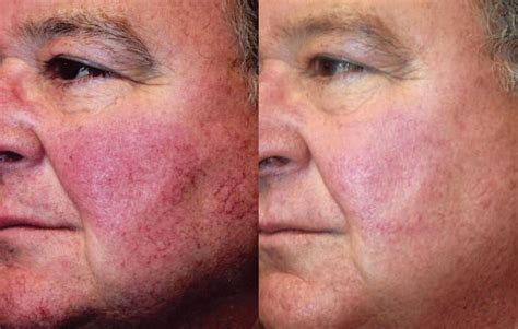 Ipl Laser For Rosacea Cosmetic Surgery Tips