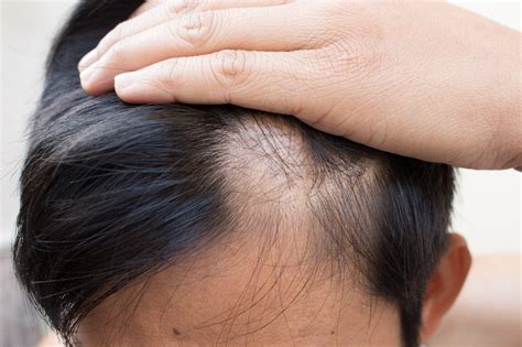 Alopecia Areata Aa Symptoms