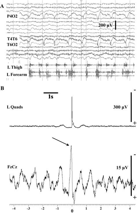 Myoclonic Status Epilepticus Case 7 A Routine Eeg While The