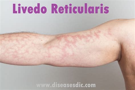 Livedo Reticularis Types Symptoms And Complications