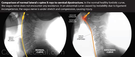 Cervical Dysstructure Cervicovagopathy