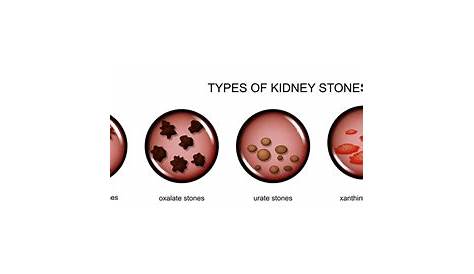 Types of Kidney Stones – Medfin