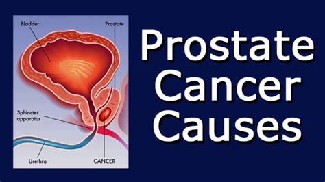 All You Need To Know About Causes Of Prostate Cancer Health Nigeria