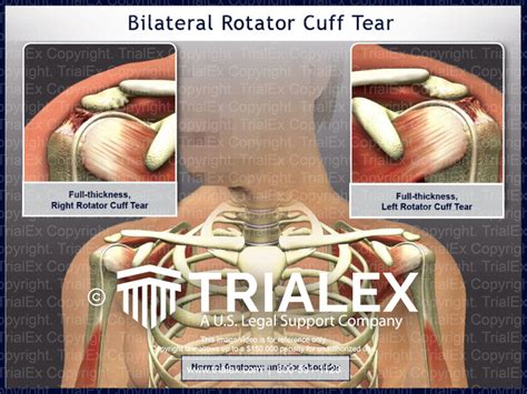 Bilateral Rotator Cuff Tear Trialexhibits Inc Free Nude Porn Photos