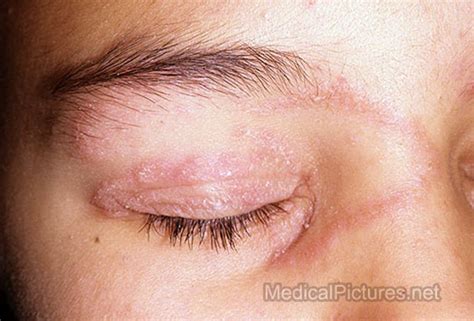 Ringworm Treatment For Adults Pictures Photos