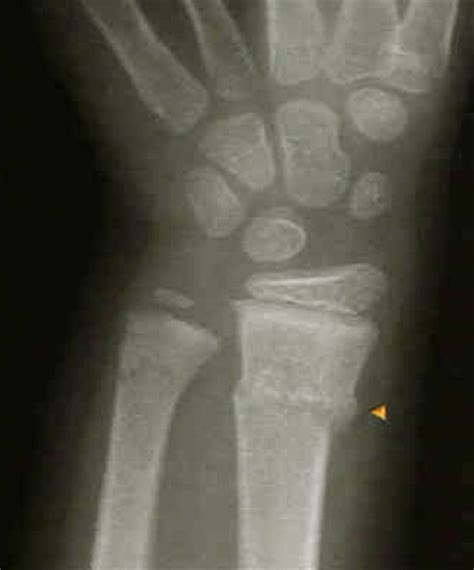 👉 Buckle Fracture Pictures Healing Time Treatment Causes February