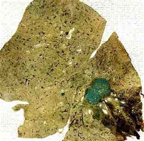 They are treated, if at all, by surgical resection, with an excellent prognosis: Sammlung Radiologie der Lungentumoren