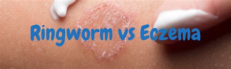 Eczema Vs Ringworm Eczema Care Company