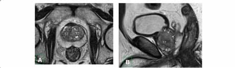 Sixty-two years old man with type 1 BPH. a Axial T2 WI ...