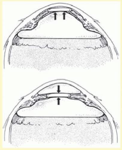 Techniques Of Scleral Buckling Ento Key