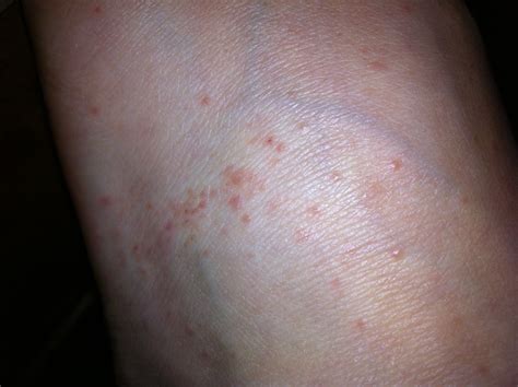 Red Rashes On Ankles Pictures Photos