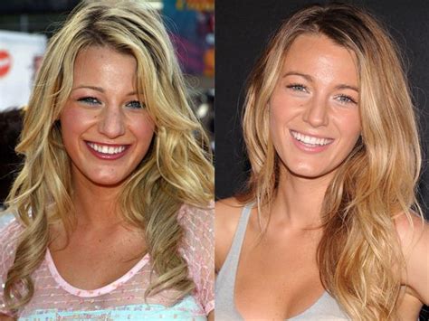 Blake Lively Nose Job Before And After Side View