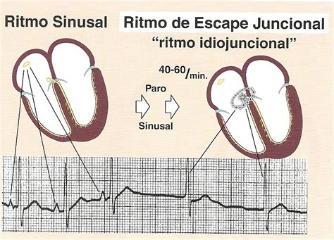 Ritmo Juncional é Perigoso