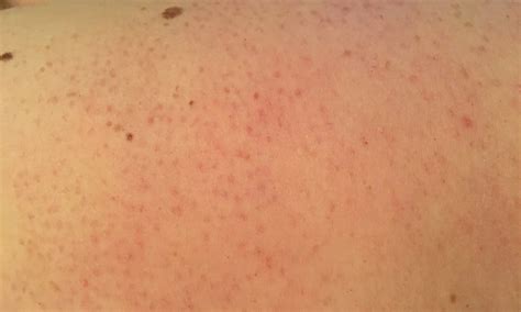 Small Red Rashes On Skin But Not Itchy Jameslemingthon Blog