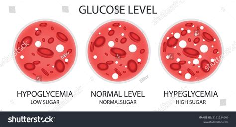 Glucose Blood Vessel Normal Level Hyperglycemia Stock Vector Royalty Free