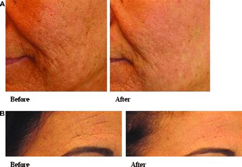 Treatment Of Facial Rhytids A B Facial Rhytids Before And 3 Months
