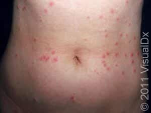 Bug Bite Or Sting Condition Treatments And Pictures For Adults Skinsight