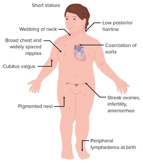 These Are The Symptoms Of Turners Syndrome Medizzy