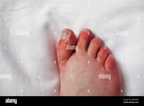 Chilblains On Toes Red Itchy Bumps Swelling Foot Of Person With