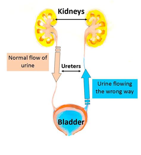 Normal On The Left And Abnormal On The Right Flow Of Urine Through