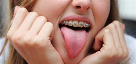 Can The Tongue Move Teeth Like Braces Do Dr Toms Orthodontics