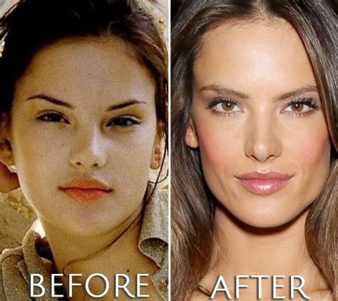 Alessandra Ambrosio Before And After Plastic Surgery Plastic Surgery