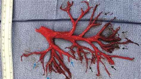 Man Dying From Heart Failure Coughs Up Blood Clot Shaped Like Lung Passage