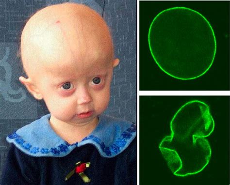 Hutchinson Gilford Progeria Syndrome Embryology