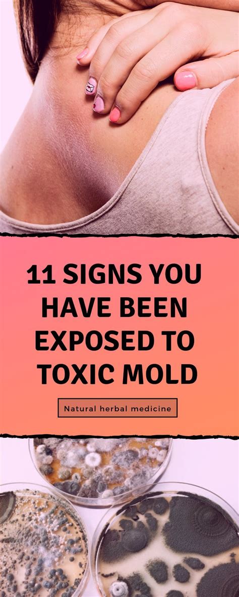 11 Signs You Have Been Exposed To Toxic Mold Toxic Mold Toxic Mold