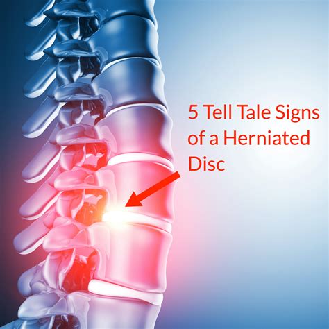 5 Tell Tale Signs Of A Herniated Disc Slipped Disc Fornham