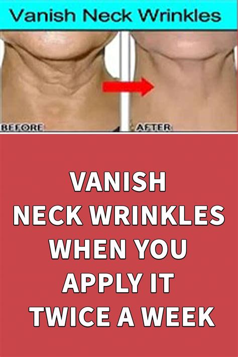 Vanish Neck Wrinkles When You Apply It Twice A Week Neck Wrinkles Neck Wrinkles Remedies