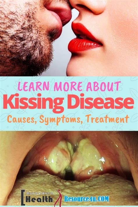 Kissing Disease Causes Symptoms Treatment Of Mononucleosis