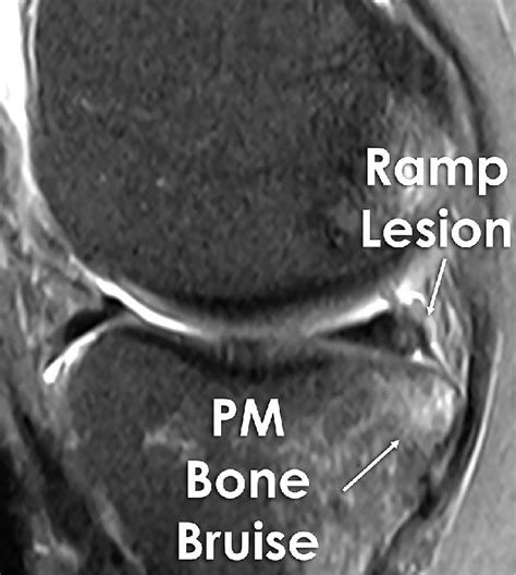 A Magnetic Resonance Image Mri Depicting A Ramp Lesion Depicted With