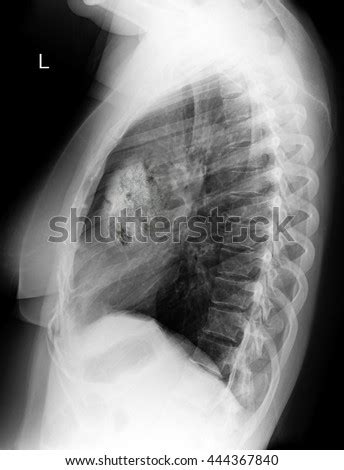 Chest Xray Image Shows Lung Cancer Stock Photo Edit Now Shutterstock