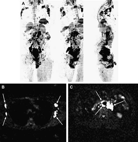 Diffusion Weighted Mr Imaging For Whole Body Metastatic Disease And