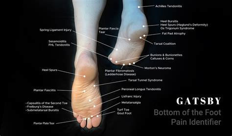 Foot Pain Chart An In Depth Guide To Identifying Foot Pain Gatsbyshoes